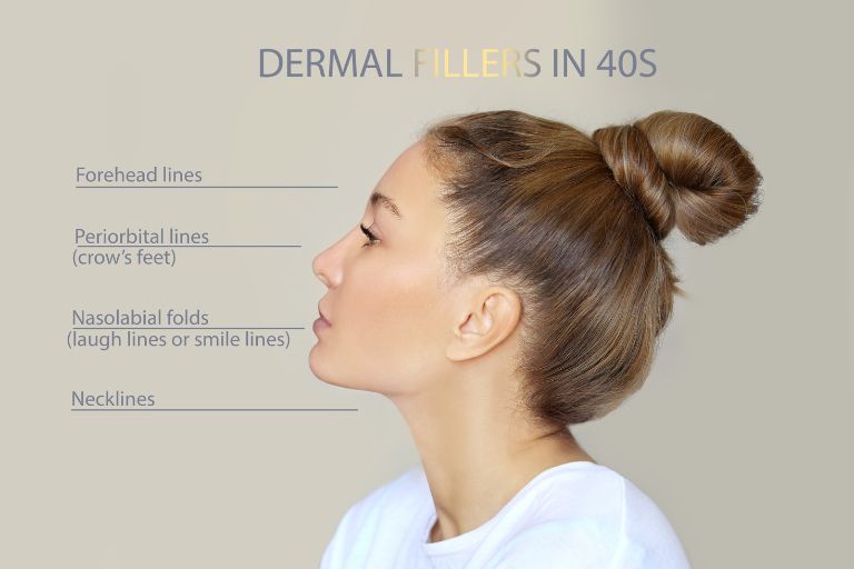 dermal fillers in 40s